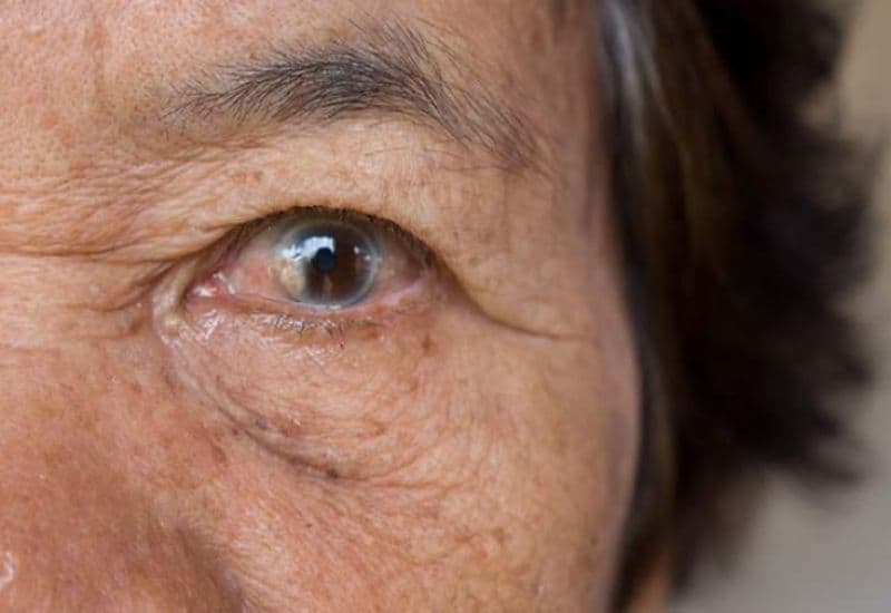 triệu chứng đục thủy tinh thể ở người già