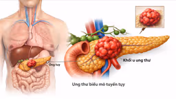 Ung thư biểu mô tuyến tụy có chữa được không? Cách dự phòng?
