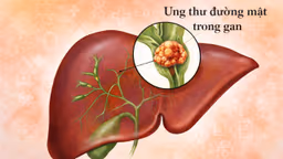 Ung thư đường mật trong gan sống được bao lâu?