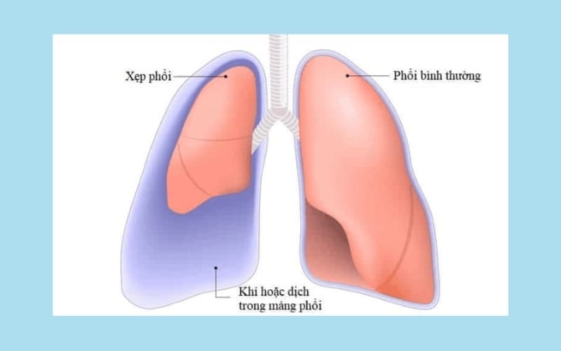 biến chứng sau cắt hạch giao cảm