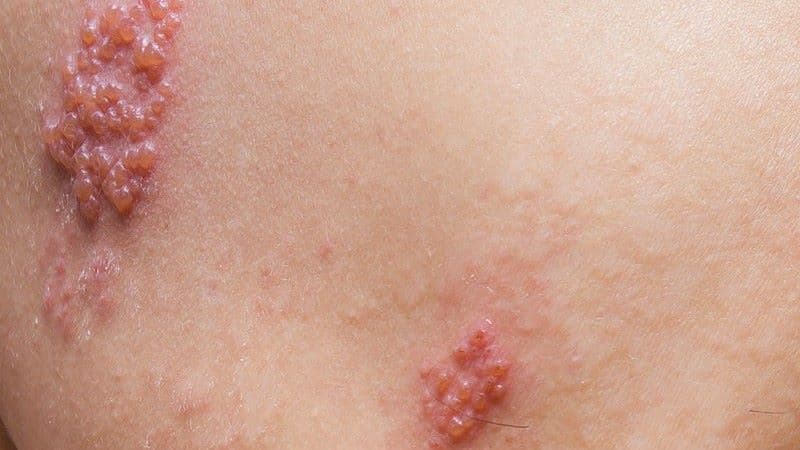 bị zona rồi có bị lại không