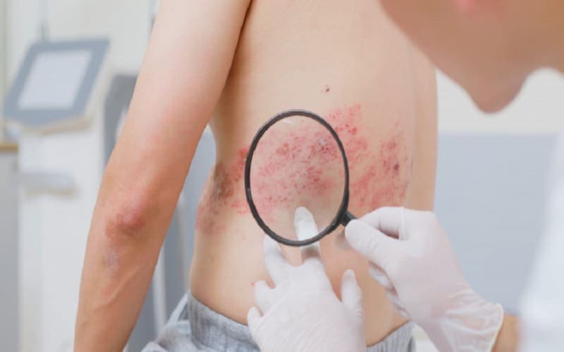 bị zona có lây không