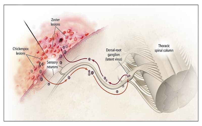 bị zona có lây không