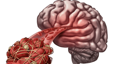 Dấu hiệu có cục máu đông trong não