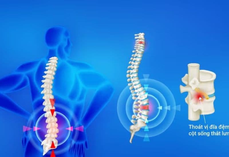 thủy châm điều trị đau lưng