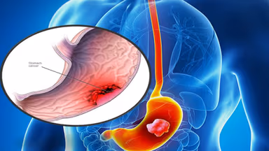 Bao nhiêu tuổi nên tầm soát ung thư tiêu hóa?