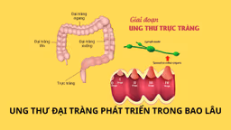 Ung thư đại tràng phát triển trong bao lâu?