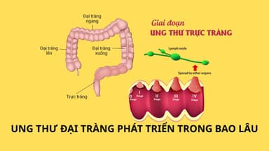 Ung thư đại tràng phát triển trong bao lâu?