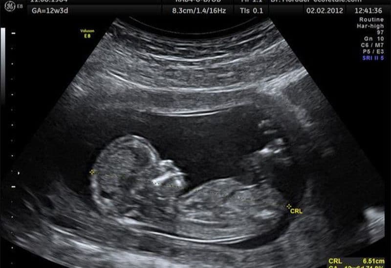 bảng chiều dài xương mũi thai nhi