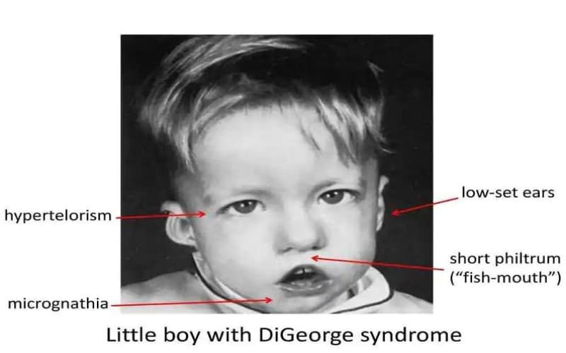 bất thường nhiễm sắc thể số 22
