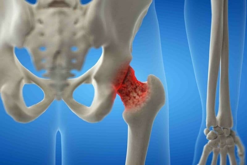 cách khắc phục bệnh loãng xương