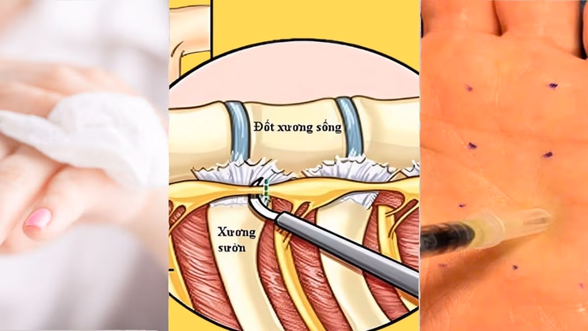 Các phương pháp điều trị tăng tiết mồ hôi: Lựa chọn nào phù hợp?