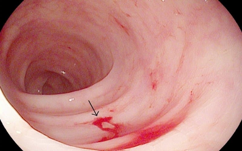 triệu chứng của polyp đại tràng ác tính