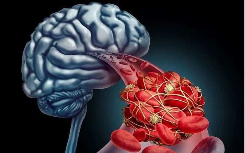 chỉ định tiêu sợi huyết trong nhồi máu não