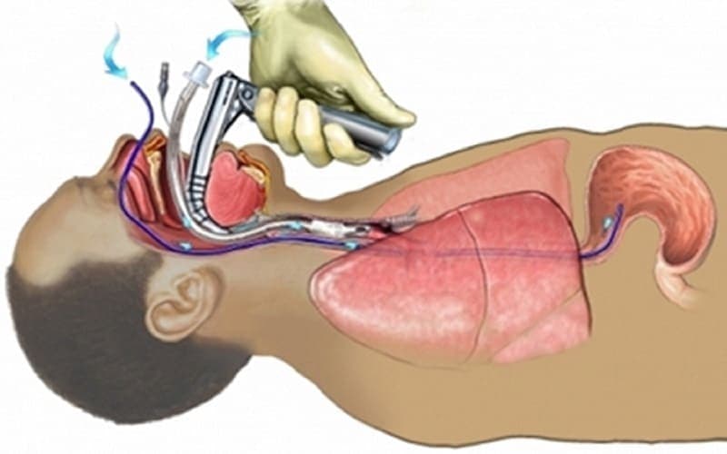 chống chỉ định đặt sonde dạ dày