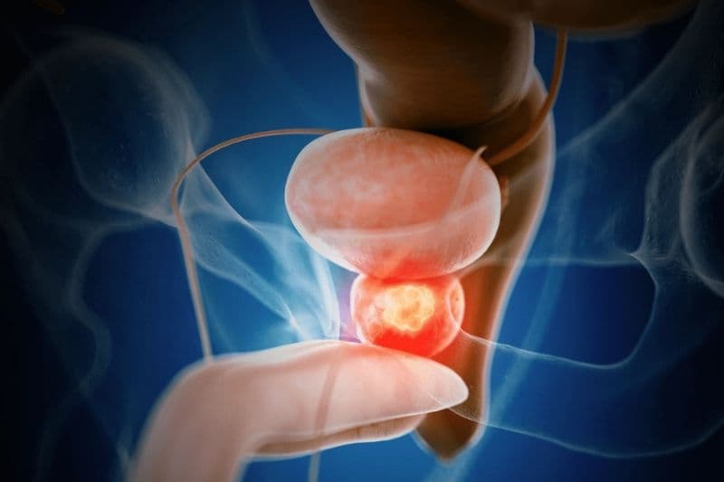 chỉ số psa trong ung thư tiền liệt tuyến