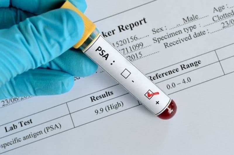chỉ số psa trong ung thư tiền liệt tuyến