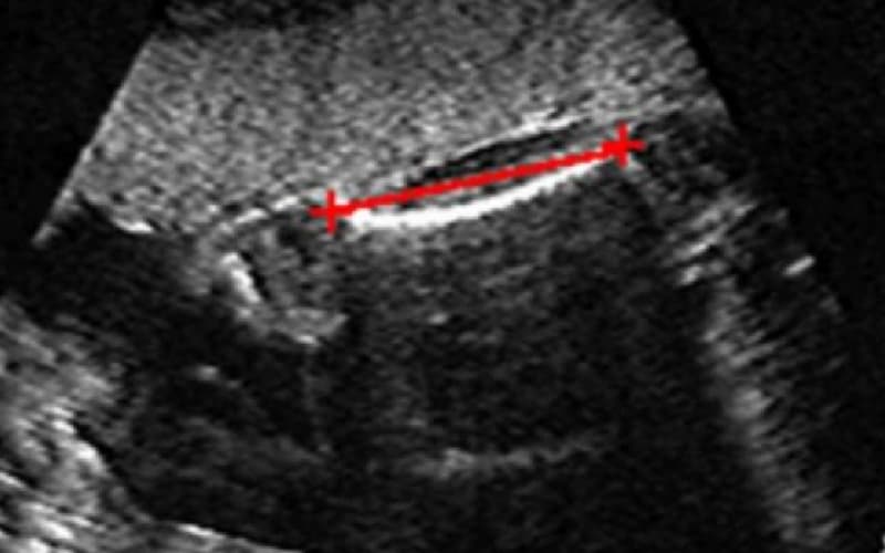 chiều dài xương đùi thai nhi