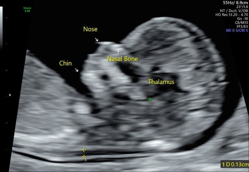 chiều dài xương mũi thai nhi 24 tuần 7mm