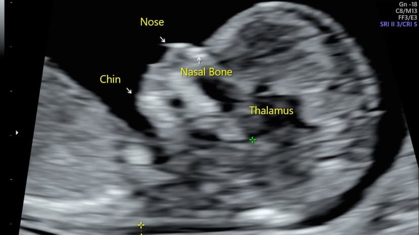 Chiều dài xương mũi thai nhi 24 tuần 7mm có bình thường không?