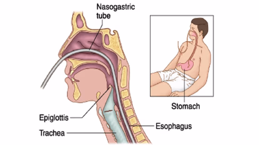 Chỉ định và chống chỉ định đặt sonde dạ dày