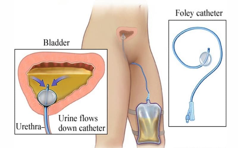 chống chỉ định đặt sonde tiểu