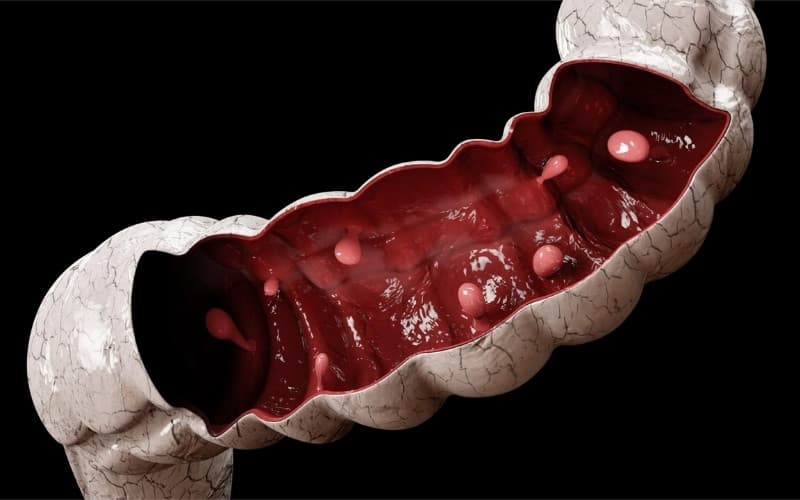 triệu chứng của polyp đại tràng ác tính
