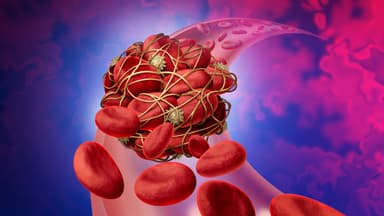 Cục máu đông trong não có nguy hiểm không?