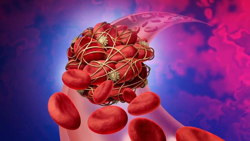 Cục máu đông trong não có nguy hiểm không?