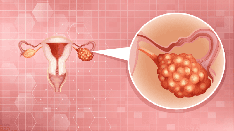 đang bị u nang buồng trứng có thai được không