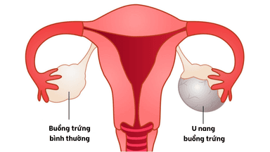 Đang bị u nang buồng trứng có thai được không?