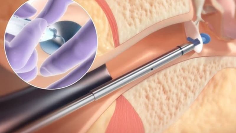 đặt ống thông khí màng nhĩ có nguy hiểm không