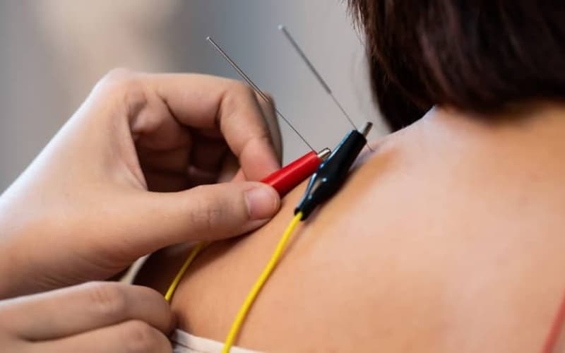 điện châm chữa đau vai gáy
