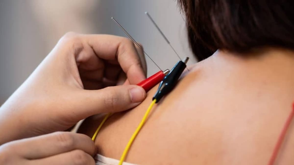 Điện châm chữa đau vai gáy có hiệu quả không và khi nào nên áp dụng?