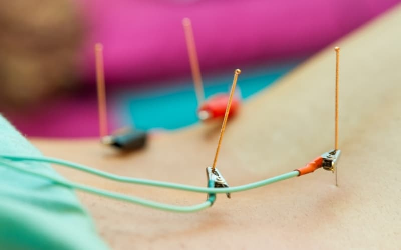 điện châm chữa đau vai gáy