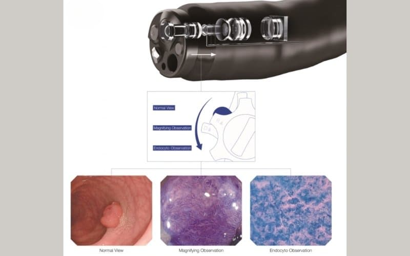 loạn sản niêm mạc dạ dày