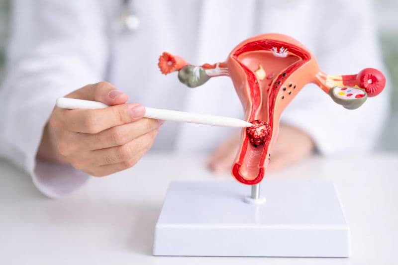 dấu hiệu ung thư cổ tử cung giai đoạn 4