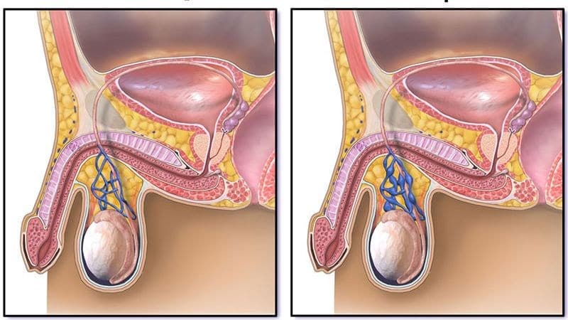 giãn tĩnh mạch thừng tinh gây rối loạn cương dương