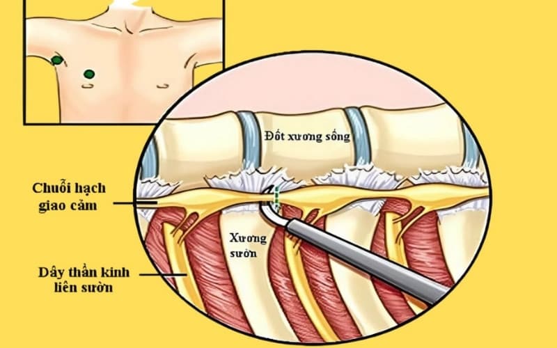 hạch giao cảm là gì