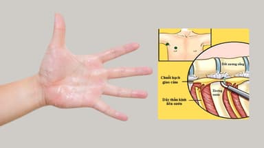 Hạch giao cảm là gì? Vai trò và mối liên hệ với tăng tiết mồ hôi