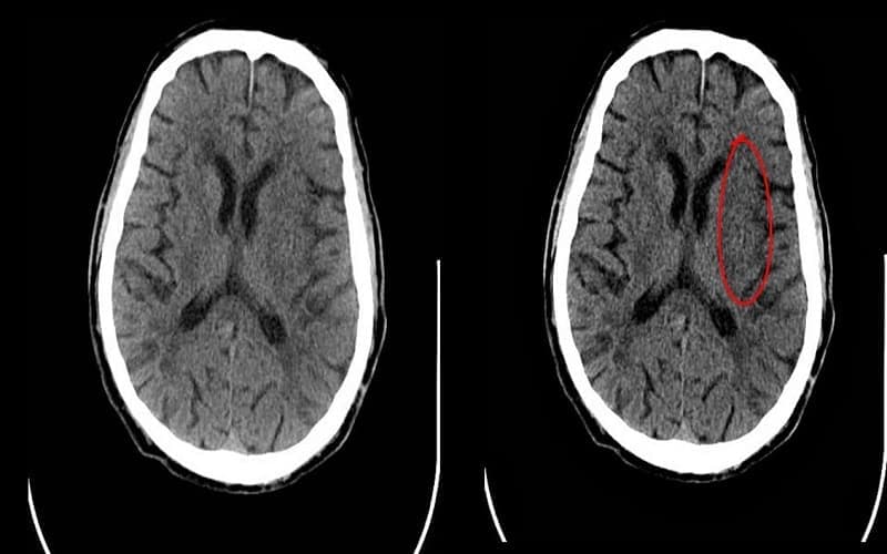 hình ảnh nhồi máu não trên ct