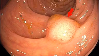 Hình ảnh polyp đại tràng ác tính và cách nhận diện qua nội soi