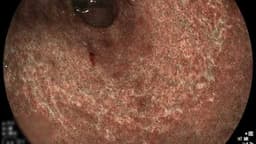 Hình ảnh viêm teo niêm mạc dạ dày dưới nội soi