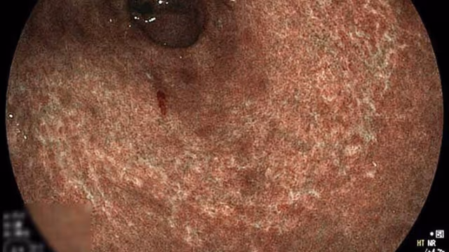 Hình ảnh viêm teo niêm mạc dạ dày dưới nội soi