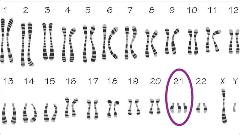 Mẹ bầu cần biết gì về hội chứng Down ở thai nhi?