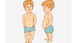 Hội chứng người lùn – Bạn thực sự biết rõ nguy cơ con mình mắc phải?