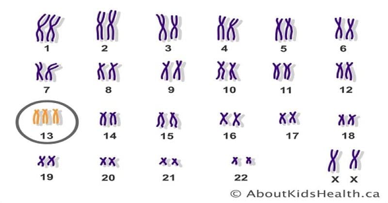 Hội chứng Patau và những điều mẹ phải biết