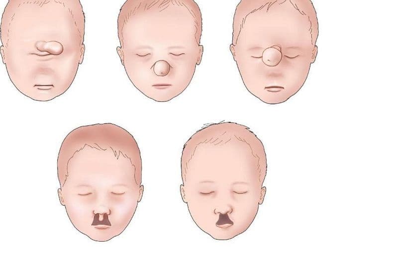 Hội chứng Patau và những điều mẹ phải biết