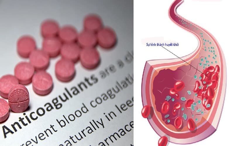 điều trị kháng đông trong rung nhĩ