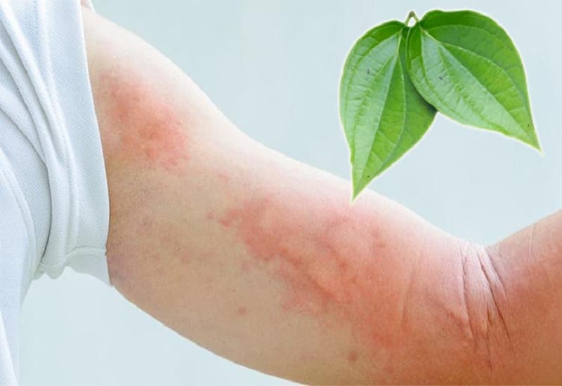cách trị mề đay bằng dân gian